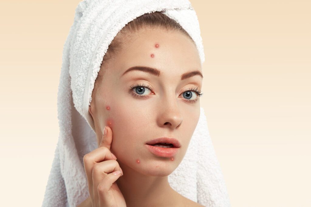 interesting-facts-about-pimples-in-tamil